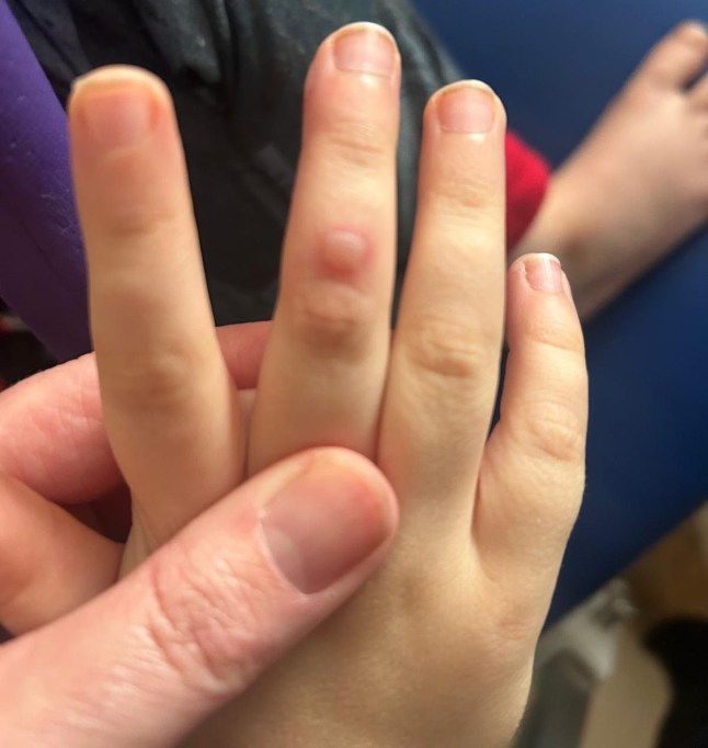 Rachel Tompkins ATT - Elaine Adams: Docs thought was Hand Foot and Mouth - but rare condition could have blinded my son