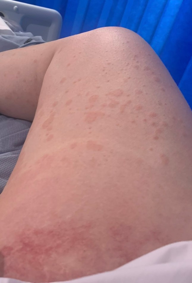 Covid vaccine injury story - For March
