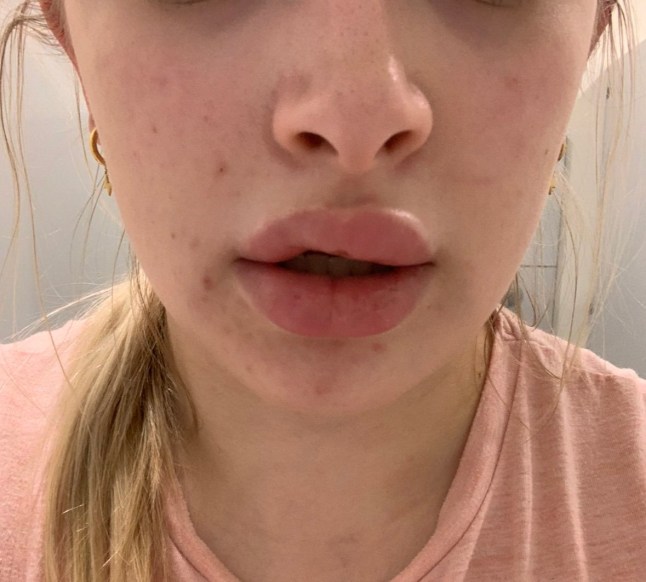 Covid vaccine injury story - For March