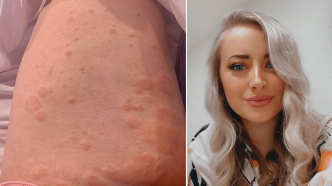 Faith Burke in a glamarous selfie on the right. On the left, she is sharing her body which is covered in a rash.